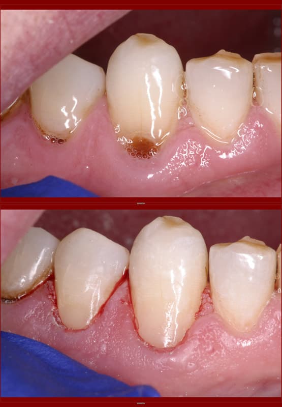 Composite Restoration