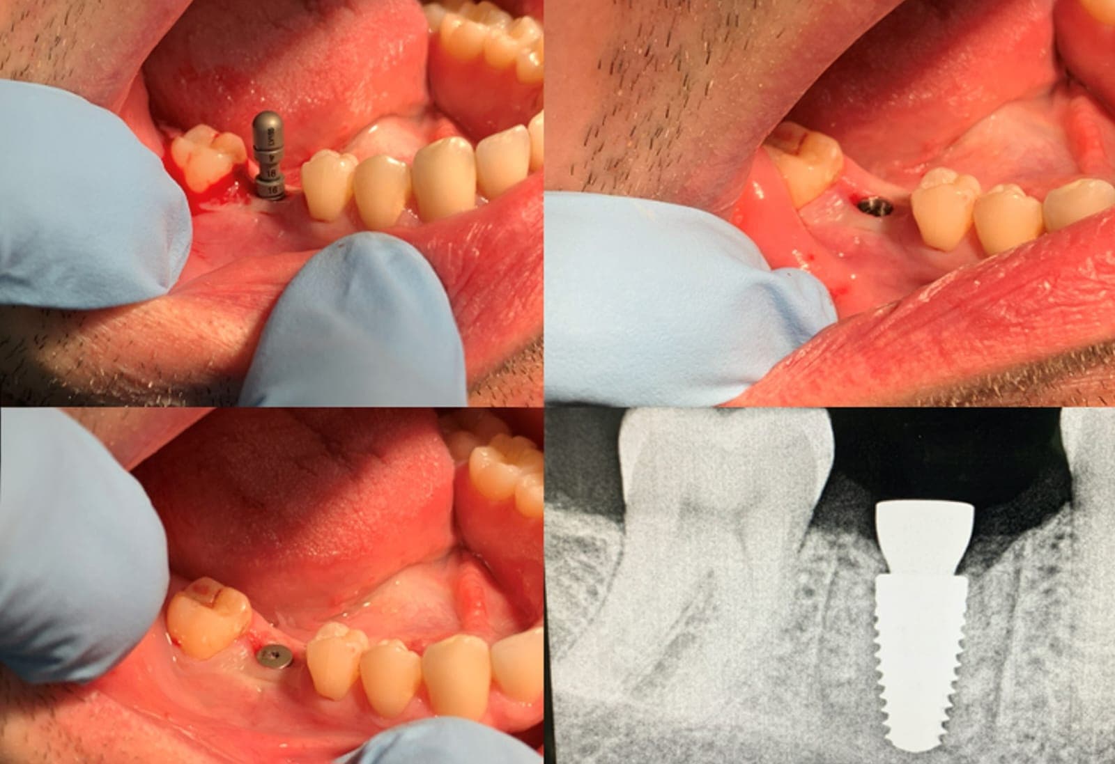 Dental Implants