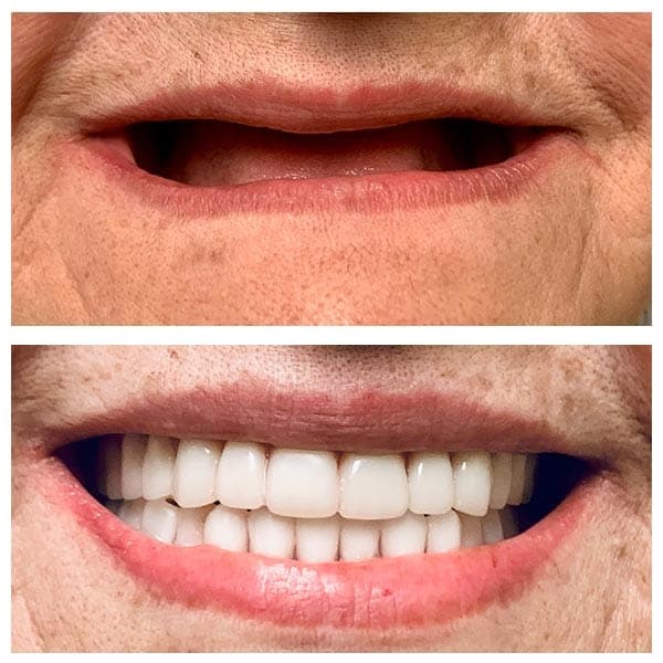 Dentures