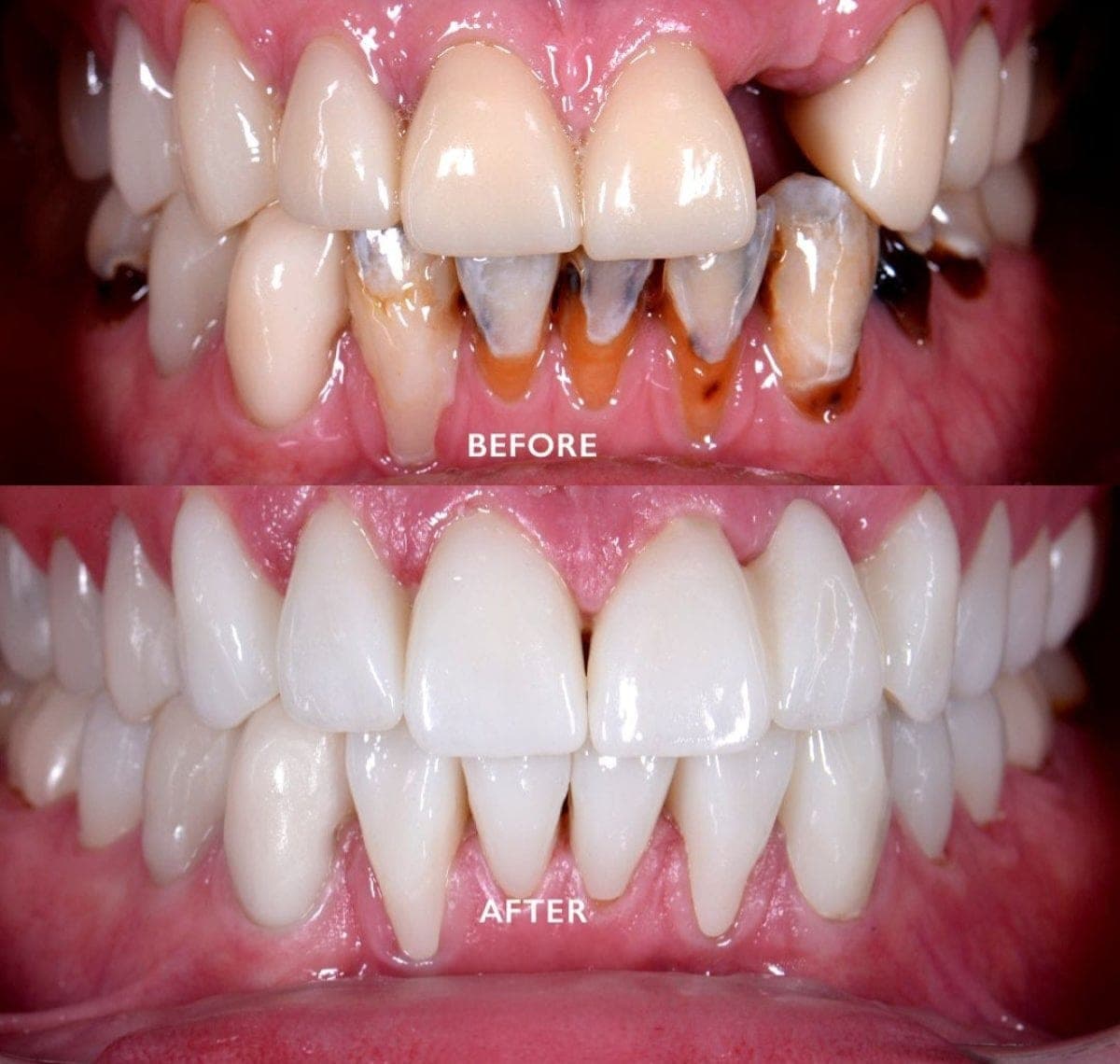 Zirconia Crown and Bridge